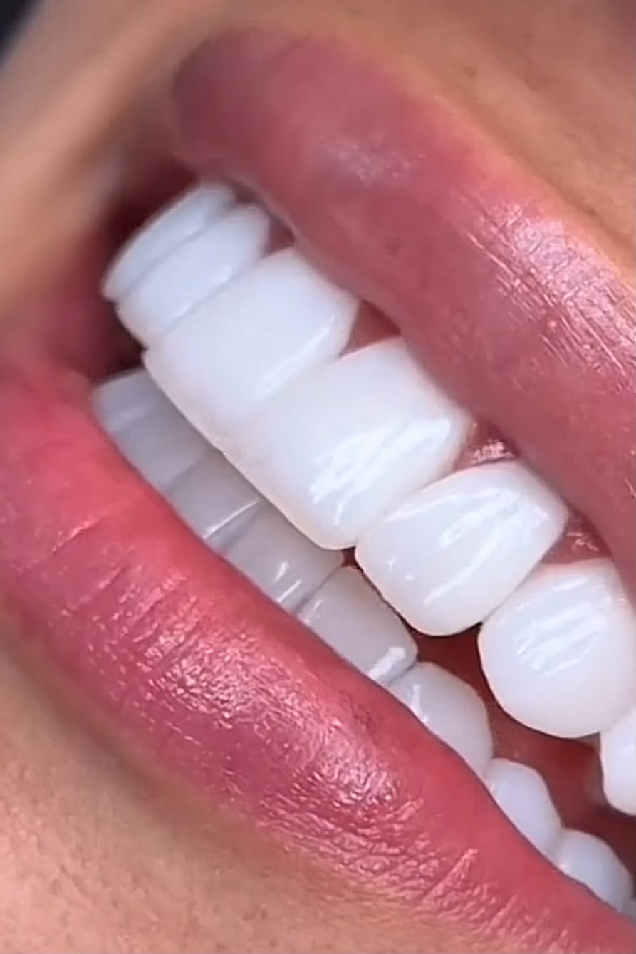 Clareamento Dental — Oral Sin Modelo