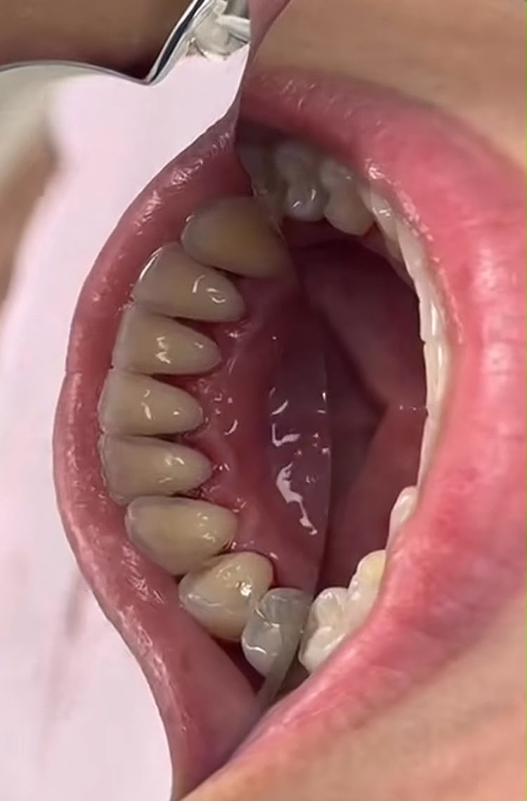Limpeza Dental — Oral Sin Modelo